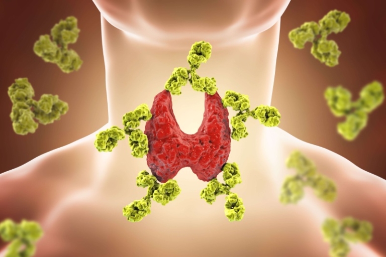 بیماری هاشیموتو چیست؟ علل، علائم و درمان