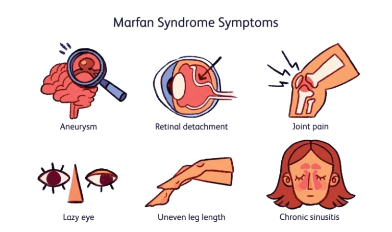سندروم مارفان چیست ؟ علائم، علل و درمان