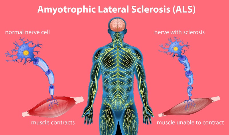 بیماری ای ال اس (als) چیست ؟ علل، علائم و درمان