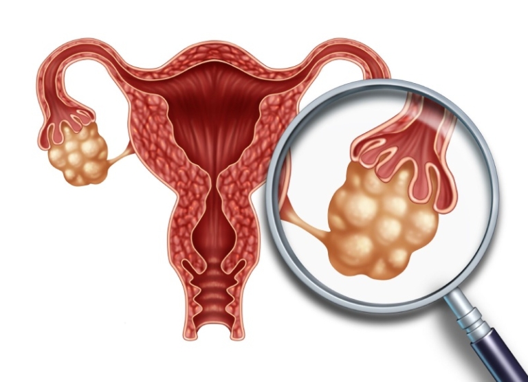 سندروم پلی کیستیک چیست؟ علائم، علل و درمان تخمدان پلی‌ کیستیک