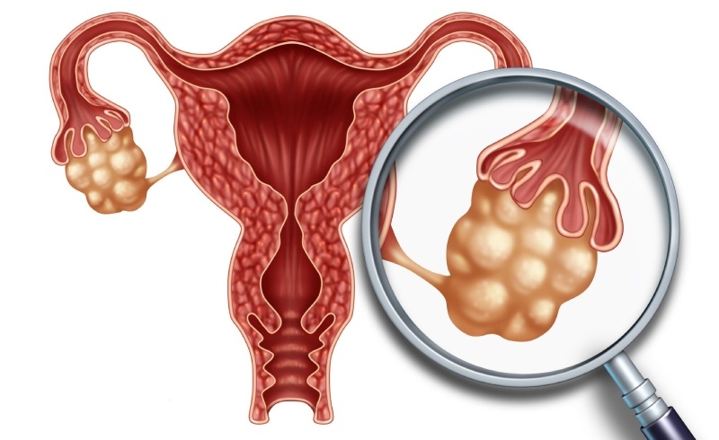 سندروم پلی کیستیک چیست؟ علائم، علل و درمان تخمدان پلی‌ کیستیک