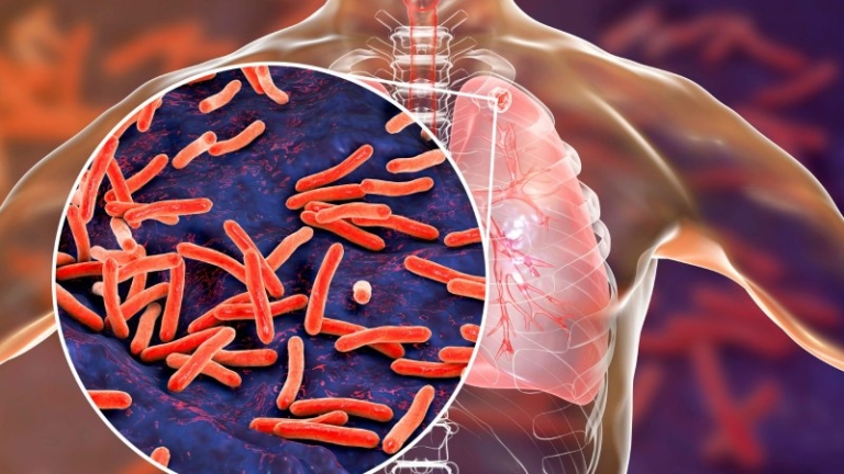 سل همچنان مرگبار ترین بیماری عفونی جهان است؛ گزارش تازه سازمان بهداشت جهانی
