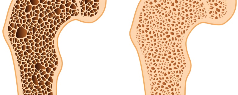 پوکی استخوان و علائم خاموش آن؛ چگونه بفهمیم استخوان‌ ها در حال تحلیل رفتن‌ هستند؟