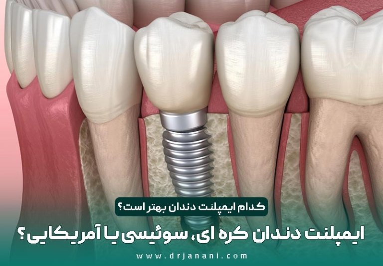 ایمپلنت دندان کره ای، سوئیسی و آمریکایی؛ کدام بهتر است؟