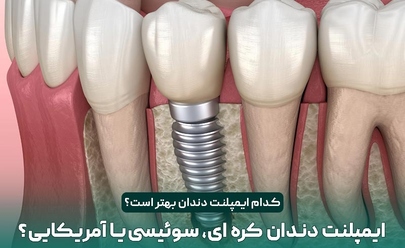 ایمپلنت دندان کره ای