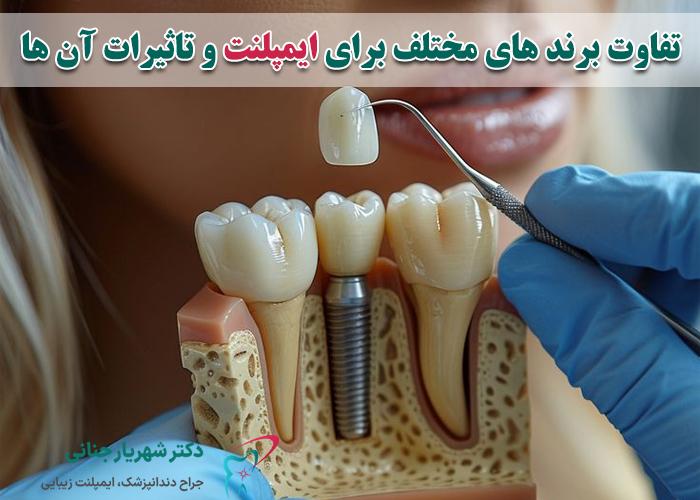 نگاهی جامع به ایمپلنت ‌های دندانی